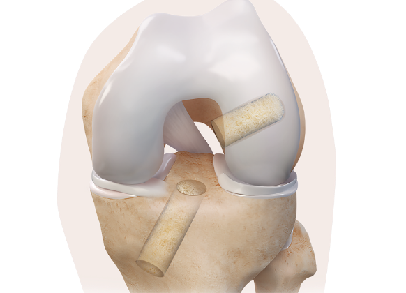 Arthrex - ACL Reconstruction